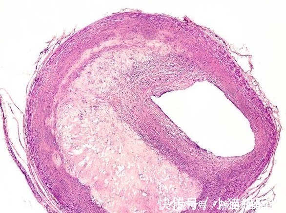 常吃|脑供血不足真凶找到了！常吃3物，多做2动作，早坚持血管早安全