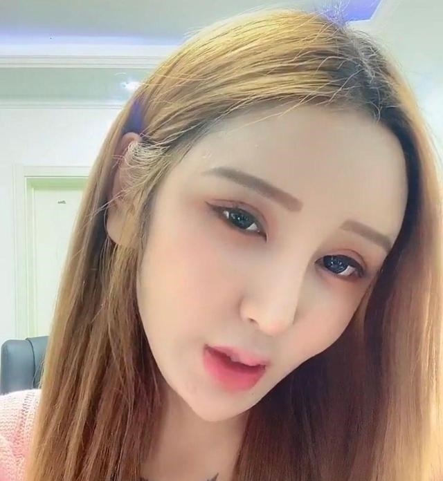 光额头 8年的整形手术花费了100多万,光额头就打了200多支玻尿酸