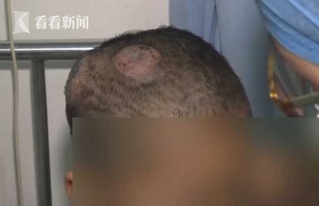 小动物|都是兔兔惹的祸！姐弟头上长脓包 头发大量掉落