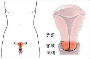 恶性肿瘤|宫颈病变有哪些？关于宫颈你知道什么？