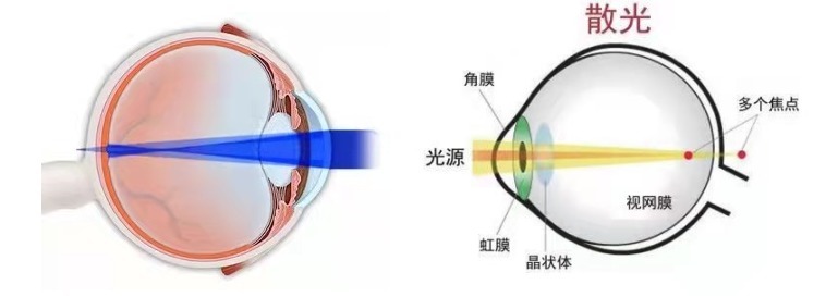 恢复|孩子散光怎么办？有可能彻底恢复吗