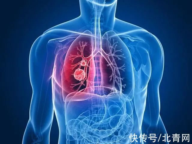 王哲|女子手指肿成“萝卜头”，一查竟是肺癌！警惕身体这些信号