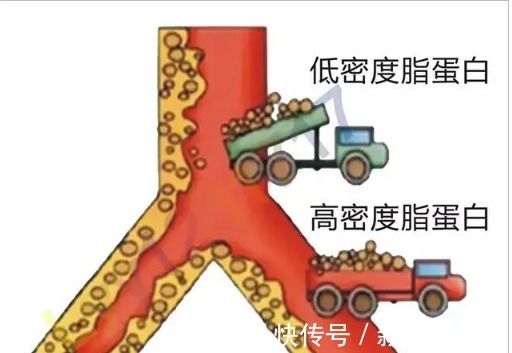 血症|高血脂不疼不痒无需在意?辟谣:高血压长期不控制会导致这些疾病