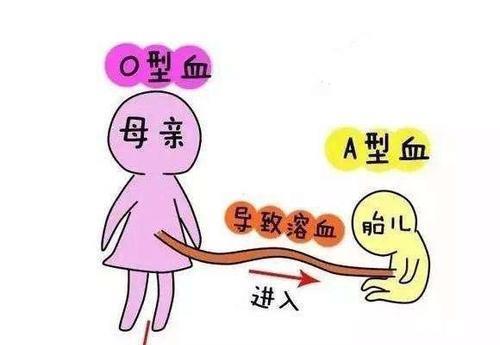 黄疸|听说过“八字不合”,但夫妻“血型不合”才最危险,孕前需检查