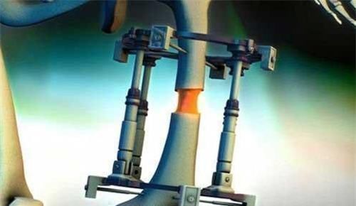 手术|为了长高7.2厘米,花16万做断骨手术的少年李亚诺,如今彻夜难眠