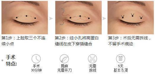 重睑术是什么?俗称割双眼皮,双眼皮手术