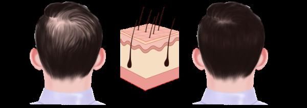 生长期|脱发和正常掉发有本质区别！