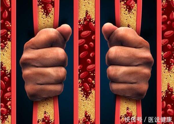 高血脂不控制,当心引发这9种并发症,每个都不能忽视