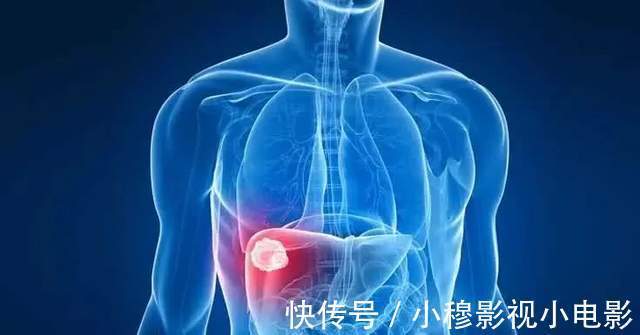 黄曲霉毒素|女频繁腹泻,双双确诊肝癌!原因令人意外