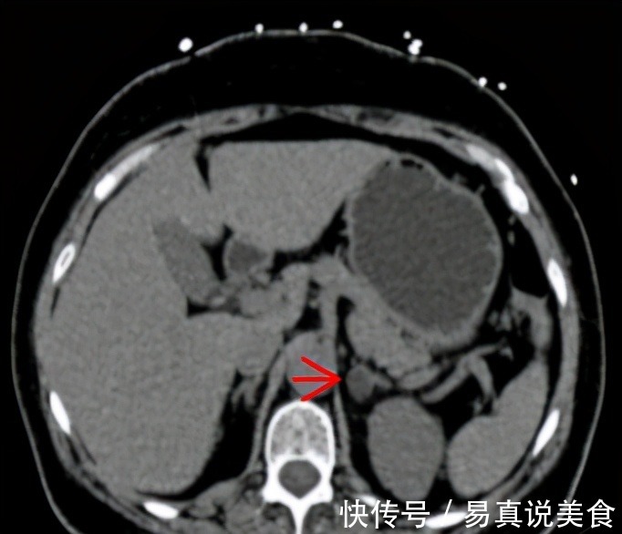 医生|血压升高了，医生却说不用吃药，为什么4种高血压不吃药也能好