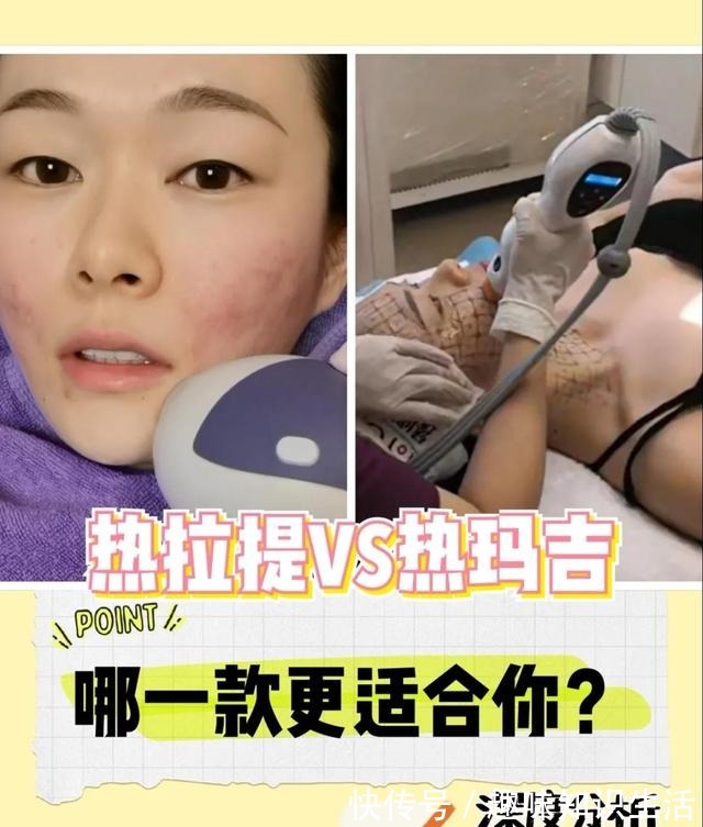 超声刀 热玛吉vs热拉提哪一款更适合你！