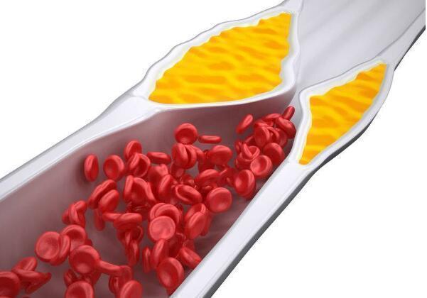 高血脂患者|血脂高先别慌,坚持做好这5点,血脂慢慢往下降,不妨试试