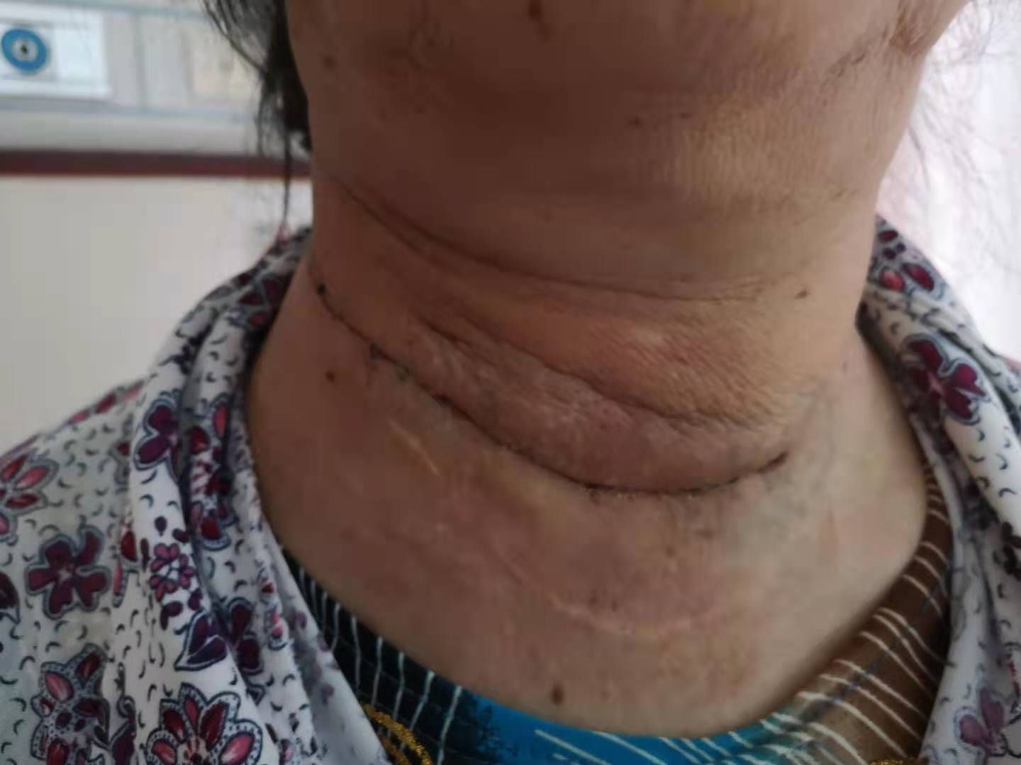 甲状腺癌|多学科协作 山大二院完成侵犯锁骨下静脉巨大甲状腺髓样癌切除术