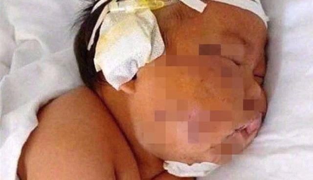 花脸猫|还记得5年前被妈妈用剪刀划成“花脸猫”的男婴吗?如今已成这样