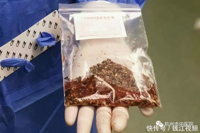 疯狂|从“疯狂的石头”到一口袋碎石子再到脓毒血症,这都经历了什么啊