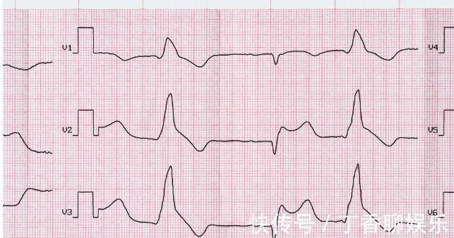 预防|这5点是冠心病最严重并发症,希望1个不要有!最全预防都在这里