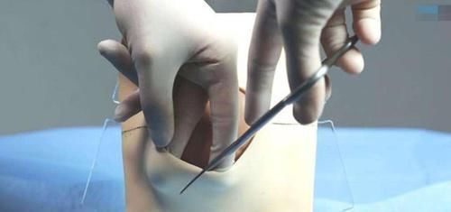 做好|明明是顺产，还要挨一刀，产科医生避免侧切，做好这5点很重要