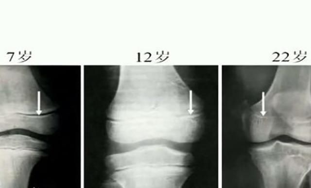 身高|为长高，妈妈每天逼女儿跳绳3000个，跳出骨骺炎后，妈妈自责不已