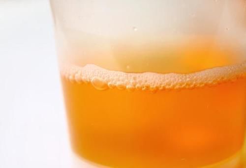 糖尿病人泡沫尿时有时无,是什么原因?本文为你说清