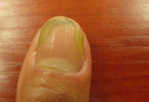 足够的重视|肝脏不好,手会发出3个“警示”,不太明显,多数人都忽视了!