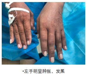 血液透析|被“偷血的手”——罕见的“窃血综合征”