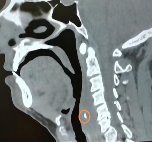 鱼刺卡喉|鱼刺卡喉用“老土方”？专家：不科学且危险！