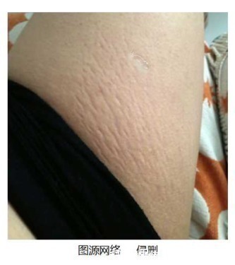 孕妇|什么时候开始预防妊娠纹?八成以上的孕妇都做错了!后悔就晚了!