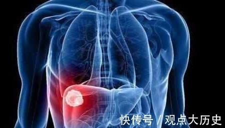 肺部|肿瘤科医生：体检时多做“这一项”检查，多数癌症能早期发现