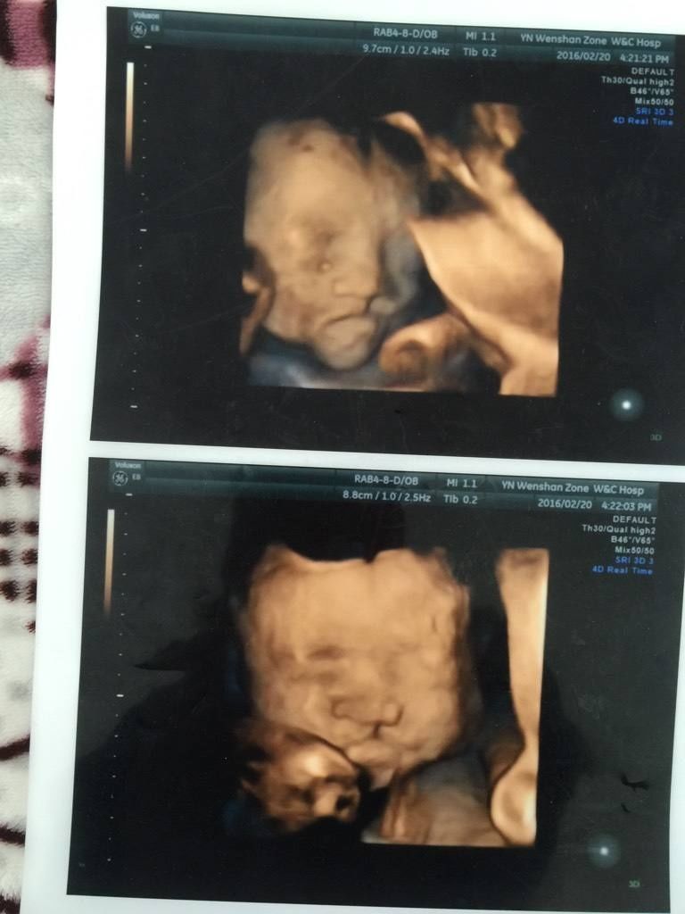 结果|意外怀孕,小两口粗心养胎,产检结果让二人后悔不已