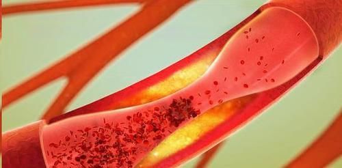 血脂高的人,早晚坚持“1件事”,血管年轻20岁,离长寿又进一步