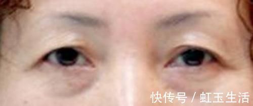 黑眼仁|上睑下垂眼无神，做个双眼皮手术就能搞定吗？