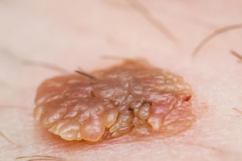 感染|90后一家三口查出感染HPV，医生：身体长小疙瘩别忽视，趁早检查