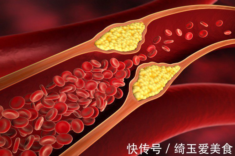 饱和脂肪|世卫组织:不吃药,降低胆固醇的10种有效方法,你也可以做到