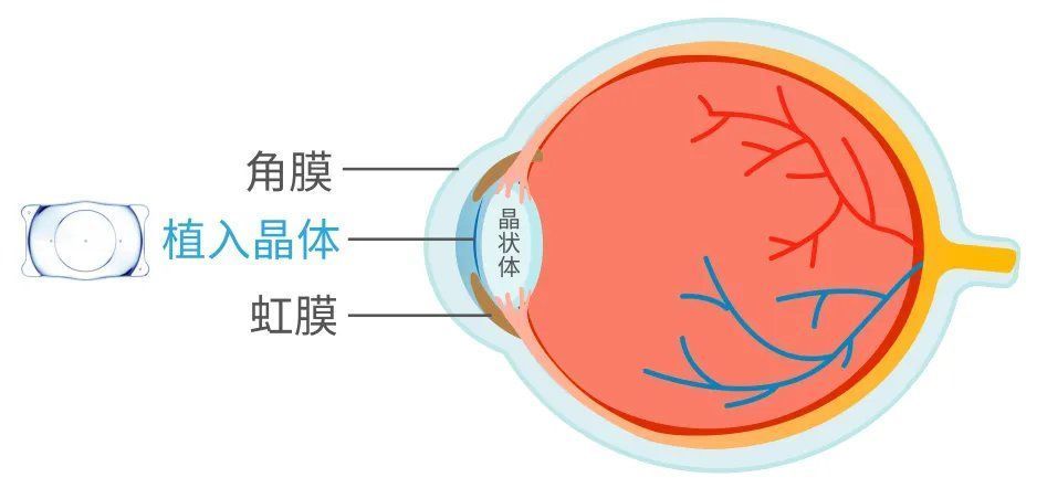 角膜|近视手术该不该做?怎么选?一文给你讲清楚