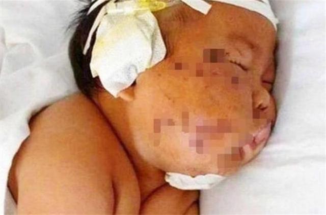 剪刀|5年前因吃奶太用力,被亲妈拿剪刀划破脸颊的男婴,现状如何?