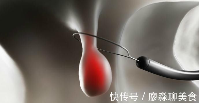 黑斑息肉|此部位长了痣，最好去检查一下大肠，大肠息肉可能已经找上了