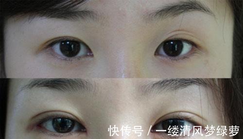 中国人|双眼皮现在还流行吗,你到底适不适合双眼皮,一起了解一下吧