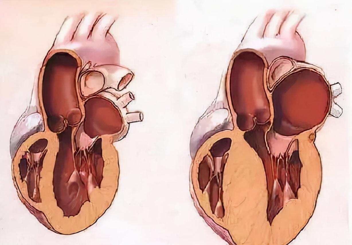 血管壁|残忍:高血压就是这样一步步“摧毁”你的!多做3事,血压能稳控