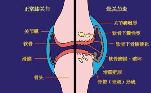 游离体|膝关节经常时咔咔的响，正常吗？