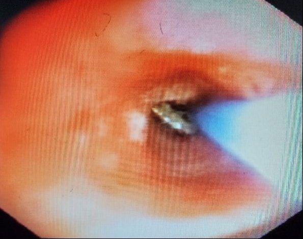 蓝军|都是辣椒尖惹的祸!中国科学院大学重庆仁济医院呼吸与危重症医学科顺利完成支气管异物取出术