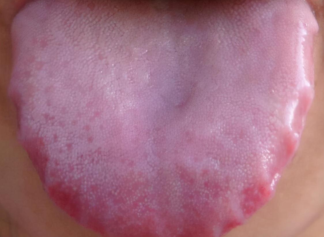 湿气|脾胃不好，舌苔白厚有齿痕、舌头有裂痕，该怎么调理？