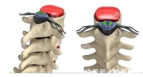 脊髓|颈椎,为何为“百病之源”!颈椎病分10级,超过2级就要注意了