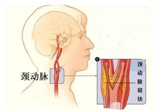 体积|男子查出颈动脉斑块，一年后复查，斑块变小了，看他是怎么做的？