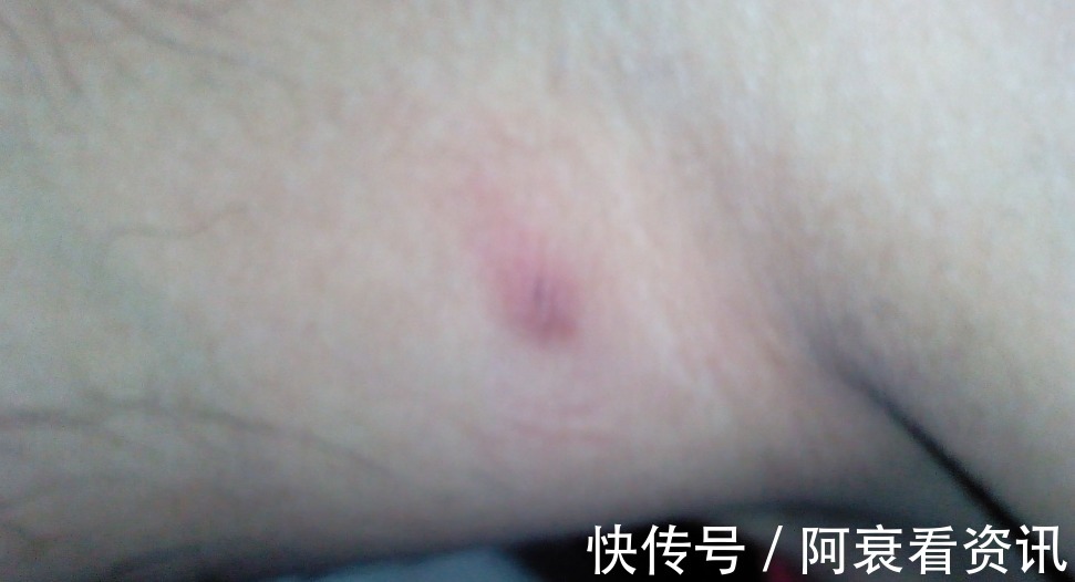 病变|HPV病变不止腹痛,内内若有3个“异常”,基本是宫颈癌晚期了