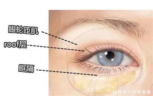 肿泡眼福音,到底怎么割,才不会出现肉条感