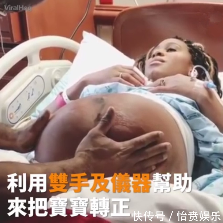 枕前位|医生徒手帮孕妈转胎位,当妈真的不容易,网友这肚皮都薄成纸了