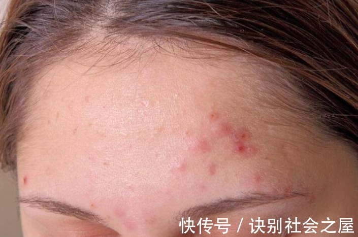 肝毒|脸上这3种表现,是肝脏毒素太多的表现!简单3招,给肝脏排毒