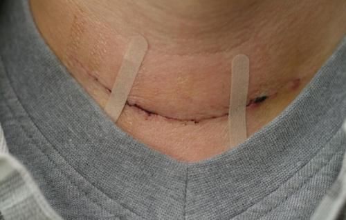 张阿姨|52岁张阿姨患甲状腺结节，医生：常吃1粗粮，比辣椒还伤甲状腺