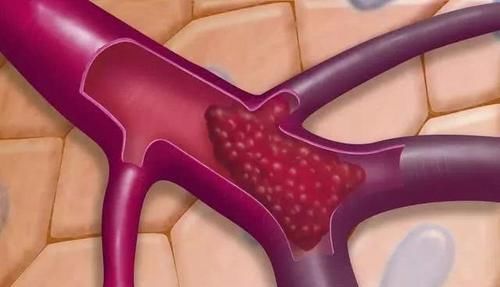 血管|天然的血液“稀释剂”, 经常吃一点, 血管畅通, 避免血栓出现