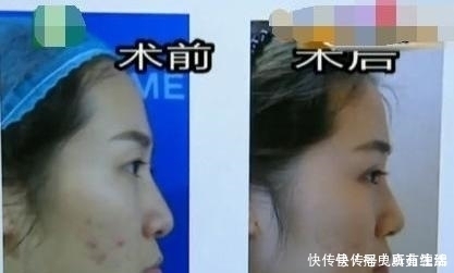 女孩|90后女孩割完双眼皮，男朋友和她提分手：你像是30岁